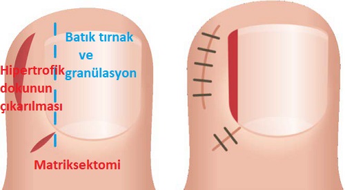 tirnak_batmasi_cerrahimatriksektomi_3.jpg