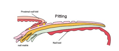 tirnakta-cukurlasma-pitting-2.jpg