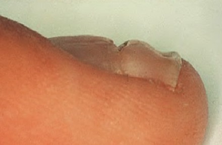 tirnakta-enlemesine-oluk-Beau-line.jpg