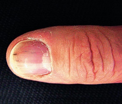 trnakta-splinter-hemoraji.jpg