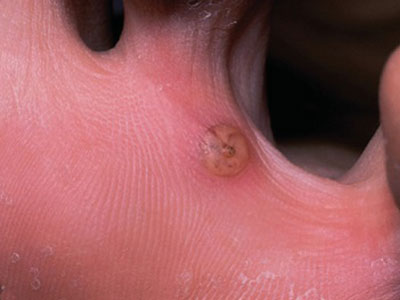 tungiasis.jpg