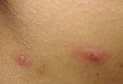 varisella-01.jpg