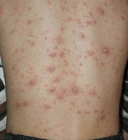 varisella-03.jpg