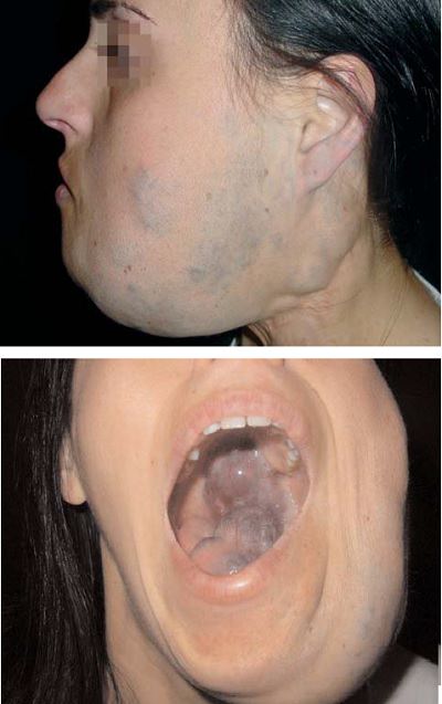 venoz_malformasyonlar_01.jpg