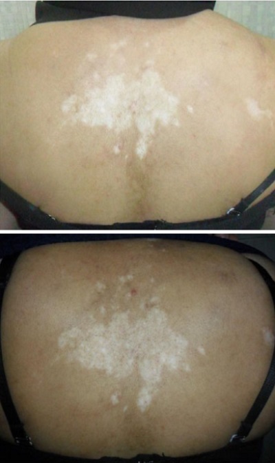 vitiligo-fraksiyonel-co2-lazer-308-nm-fototedavi-PRP-2.jpg