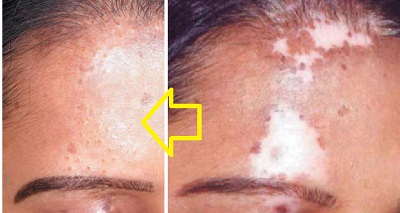 vitiligo-vitiligo-cerrahisi-mikrogreft-6.jpg