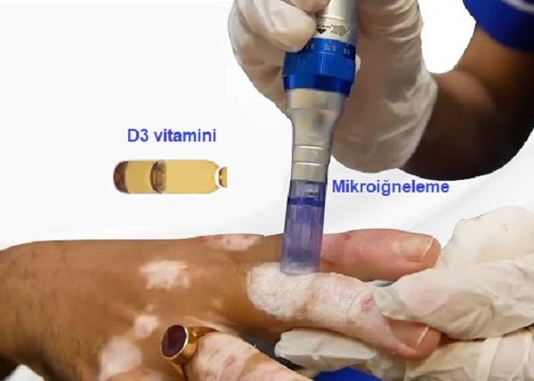 Vitiligo Mikroiğneleme D Vitamini Tedavileri 