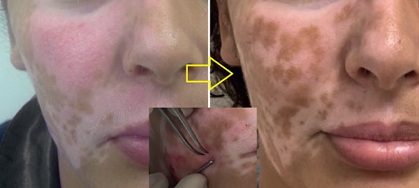 vitiligo_tedavi_cerrahi_deri_greft_micropunch.jpg