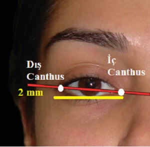 Yüzde Göz ve Göz Kapaklarının Estetik Analizi
