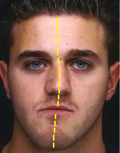 Yüz Estetik Analizinde Yüz Simetrisi ve Yüz Asimetrisi
