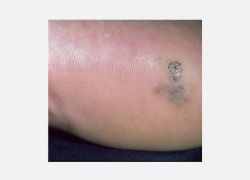 Akral Lentiginous Melanoma