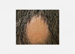 Alopecia Areata