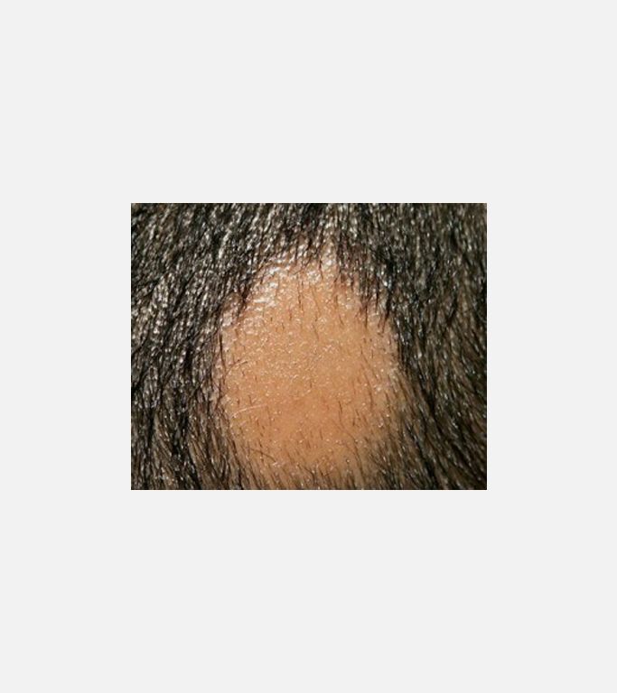 Alopecia Areata