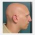 Alopecia Universalis