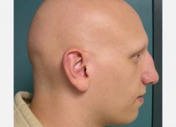 Alopecia Universalis