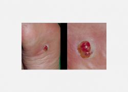 Amelnositik Melanoma