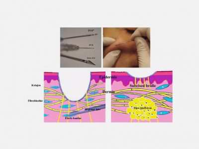 Atrofik Skarlarda Yağ Enjeksiyonu