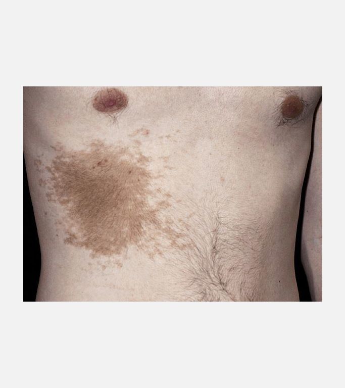 Becker's Nevus