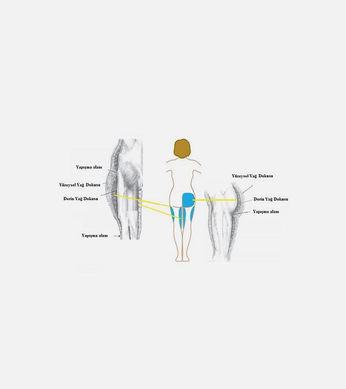 Uyluk ve Popo Yağ dokusu