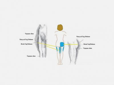 Uyluk ve Popo Yağ dokusu