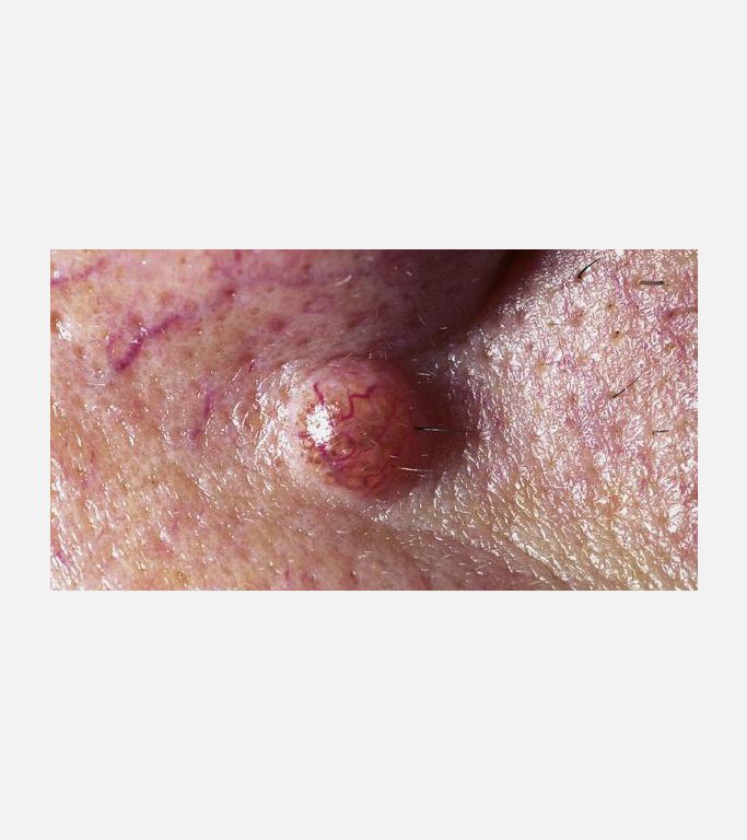 Burun kenarında dermal nevus