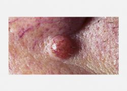 Burun kenarında dermal nevus