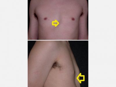 Pectus excavatum; Kunduracı Göğsü Hafif Olgularda Yağ enjeksiyonu