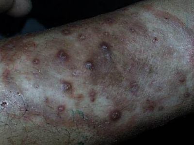 Kolda tüylerin alınması sonrası majorcchi granuloma gelişimi