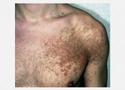 Becker’s Nevus