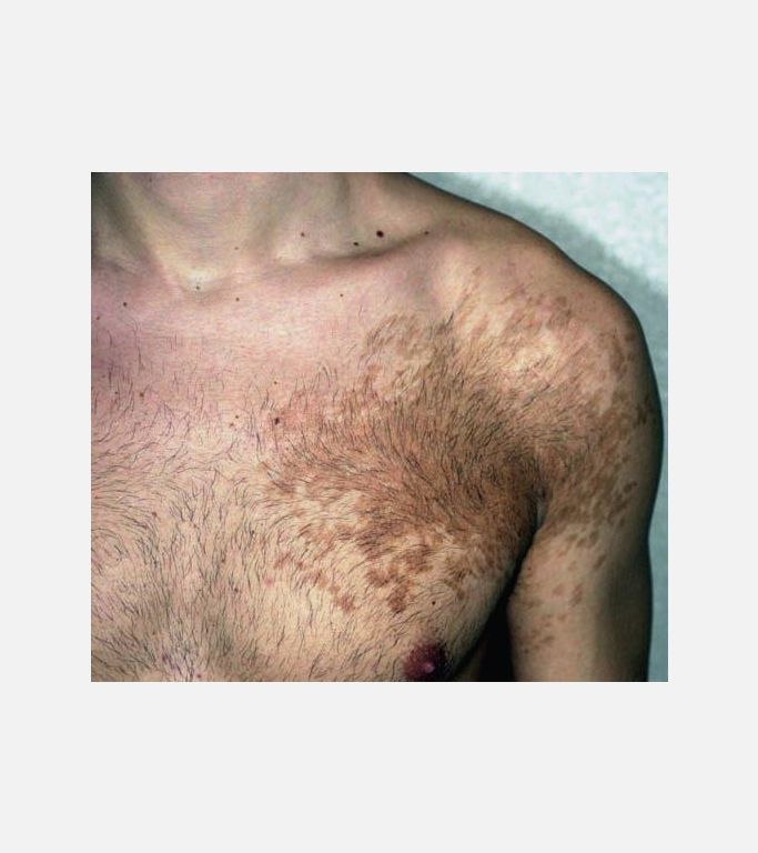 Becker’s Nevus