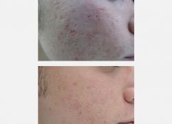 Kimyasal Peeling ve Noktasal Peeling (TCA spot)