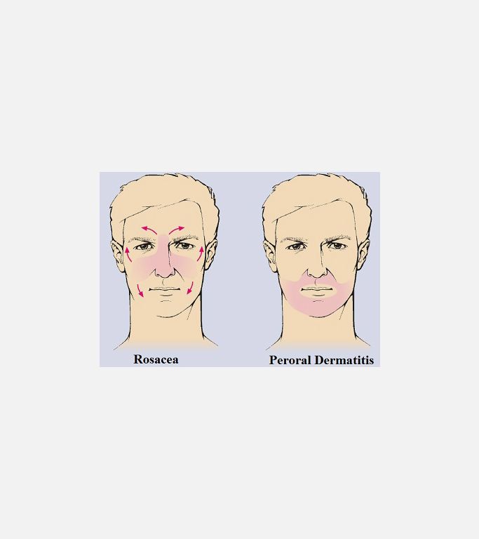 Peroral Dermatitis'in Klinik Belirtileri