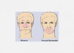 Peroral Dermatitis'in Klinik Belirtileri