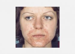 Peroral Dermatitis'in Klinik Belirtileri