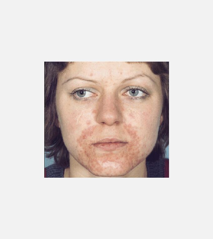 Peroral Dermatitis'in Klinik Belirtileri