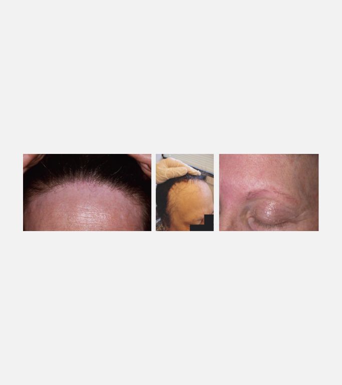 Frontal fibrosing alopecia