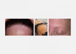 Frontal fibrosing alopecia