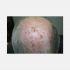 Erosive pustular dermatosis of the scalp