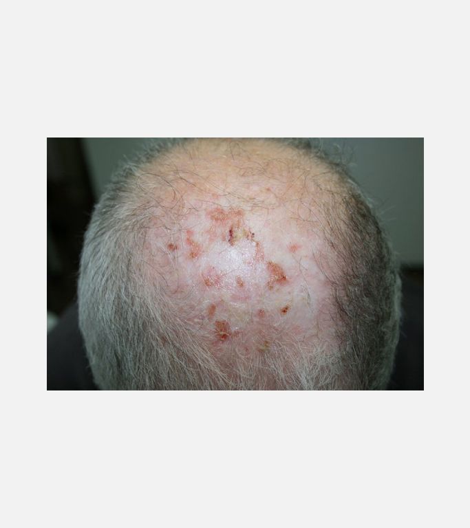 Erosive pustular dermatosis of the scalp