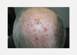 Erosive pustular dermatosis of the scalp