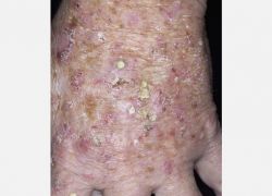 Liken planusa benzer keratosis