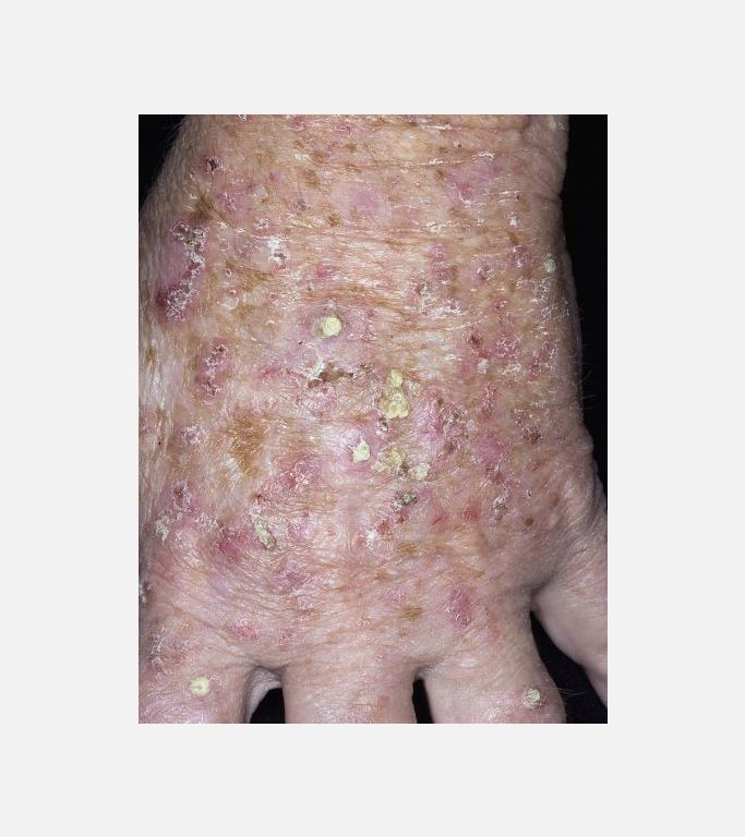 Liken planusa benzer keratosis