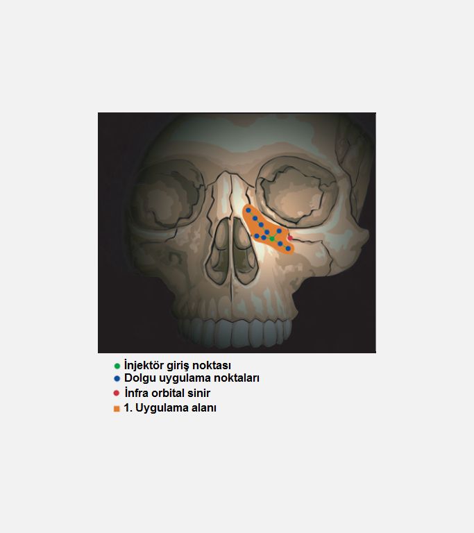 1. uygulama alanı; infraobital nerve mediladine orbital rimin 1 cm altından başlanmakta.