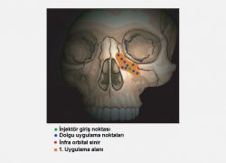 1. uygulama alanı; infraobital nerve mediladine orbital rimin 1 cm altından başlanmakta.