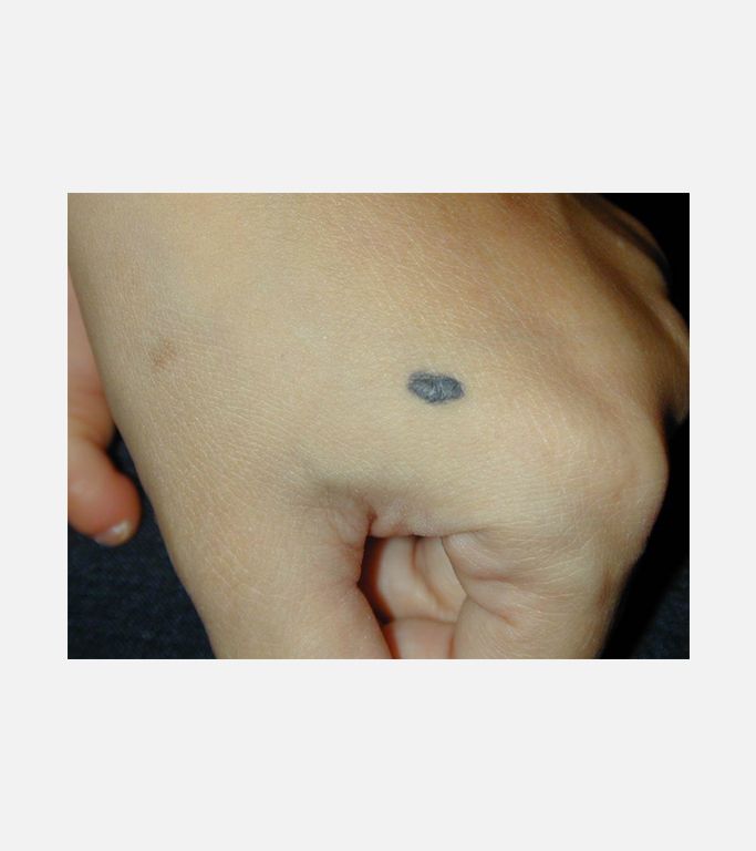 Mavi Nevus (Blue Nevus)