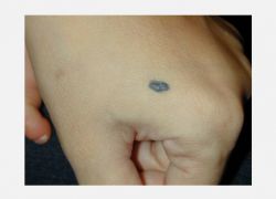 Mavi Nevus (Blue Nevus)