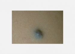 Mavi Nevus (Blue Nevus)