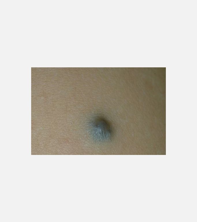 Mavi Nevus (Blue Nevus)