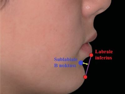 Mentolabial fold