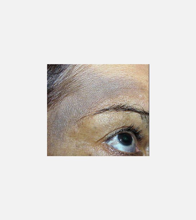 Nevus Of Ota (oculodermal melanocytosis)